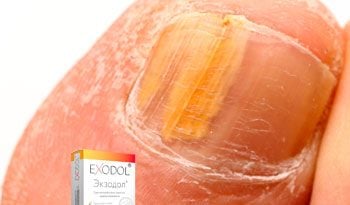 Exodol – средство от грибковых поражений кожи