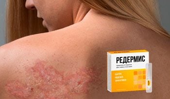 Редермис – быстрое и надежное избавление от псориаза