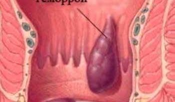 Живой гель от геморроя: механизм действия и инструкция по применению